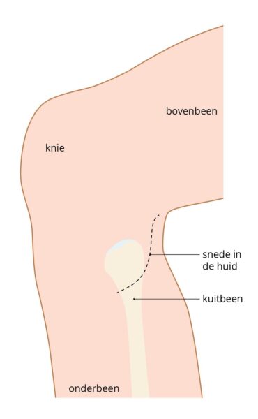 afbeelding incisie