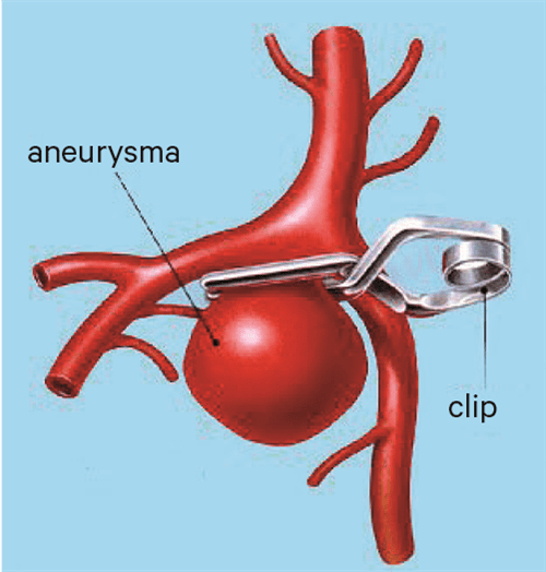 aneurysma hersenen clipping fig 01