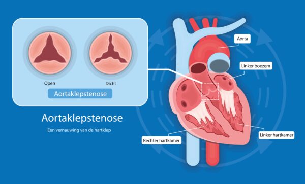 aortaklep1_scherp.jpg