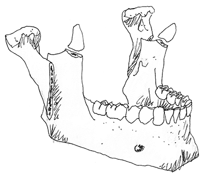 chirurgische_kaakcorrectie_image1.png