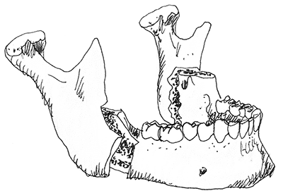 chirurgische_kaakcorrectie_image2.png