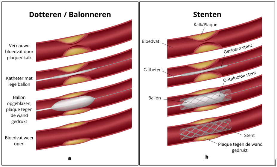 Dotteren, balonneren en Stenten