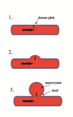 hersenbloeding subarachnoidale bloeding fig 01