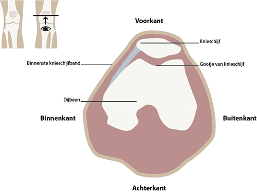 instabiliteit_van_de_knieschijf_fig1.png