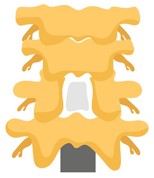 laminectomy_bewerkt_100dpi.jpg