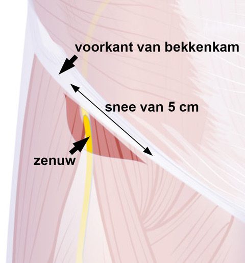 meralgia_incisie_bewerkt.jpeg