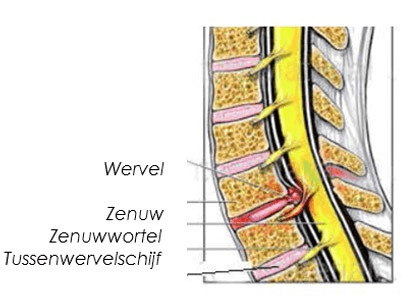 nekhernia2.jpeg