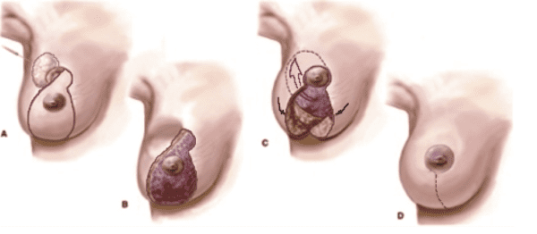 oncoplastische_reconstructie_dmv_borstverkleining.png
