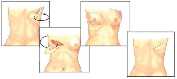 oncoplastische_reconstructie_tdap_lap.png