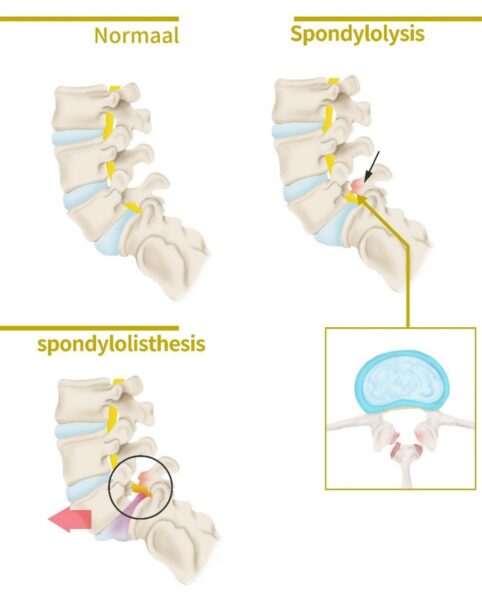 spondylodese