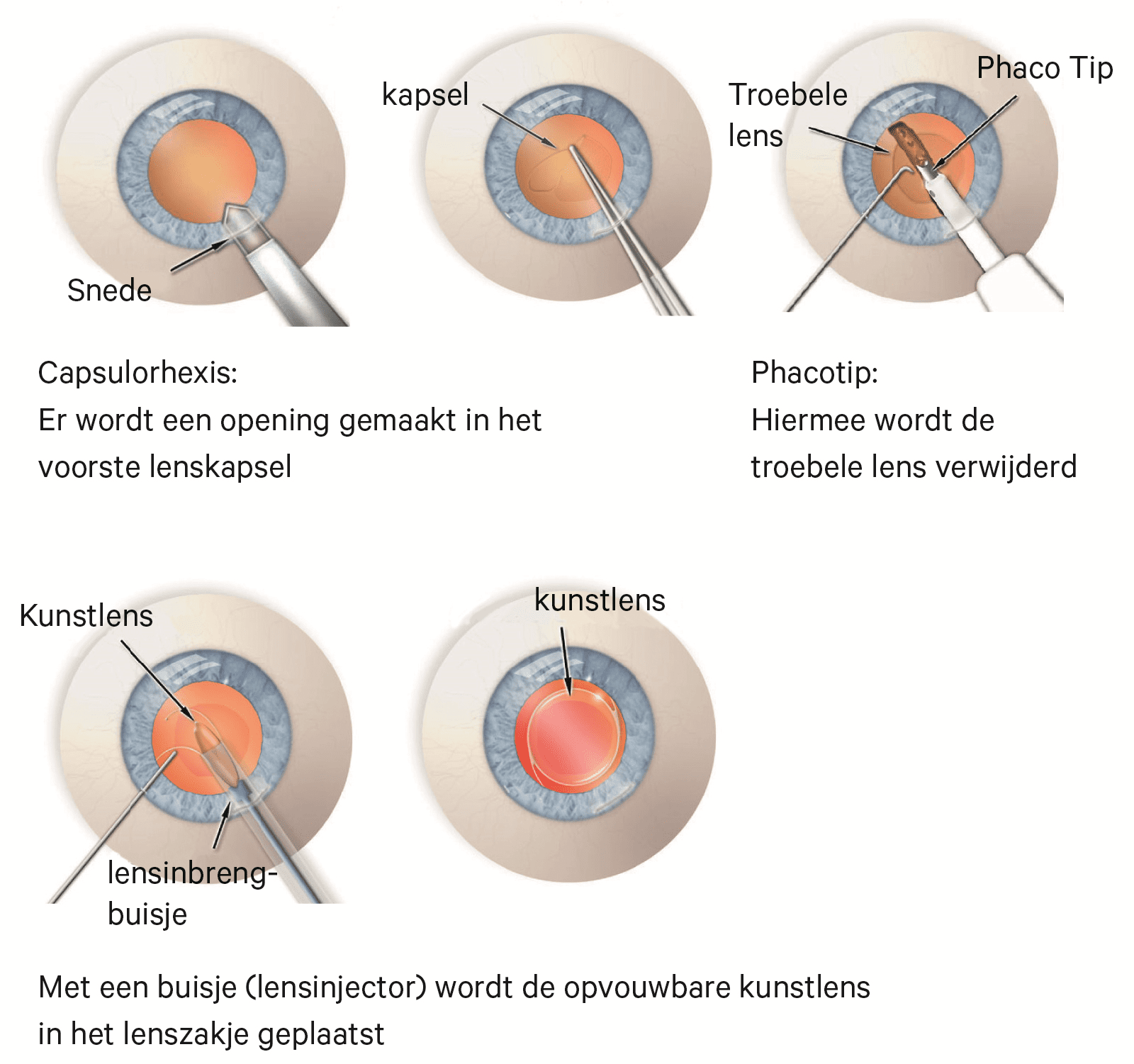 Er wordt een opening gemaakt in voorste lenskapsel. Hiermee wordt de troebele lens verwijderd. Met een buisje wordt opvouwbare kunstlens in lenszaktje geplaatst.