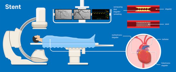stent_1136px.jpg