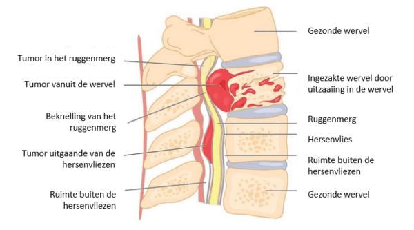 uitzaaiingen_in_wervelkolom_fig01.png