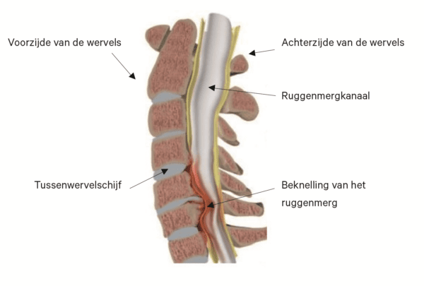 vernauwing_wervelkanaal_2.jpeg