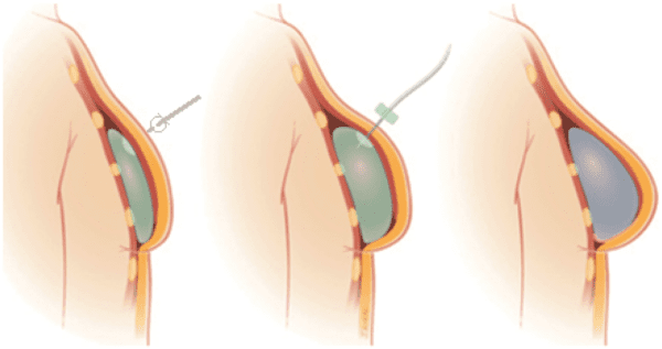 vullen_van_tissue_expander.png