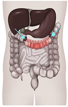 transversum resectie