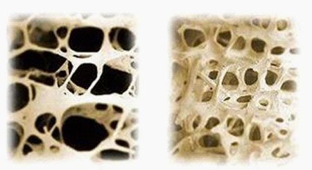 Osteoporose (links) en normaal bot (rechts)
