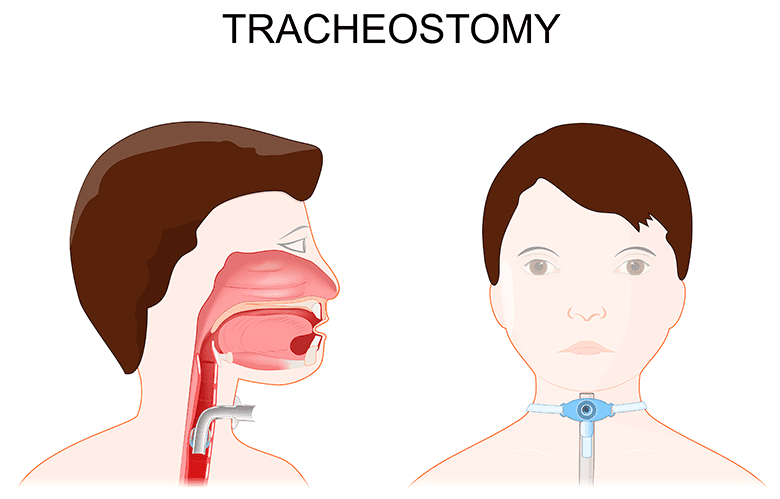 Tracheometrie