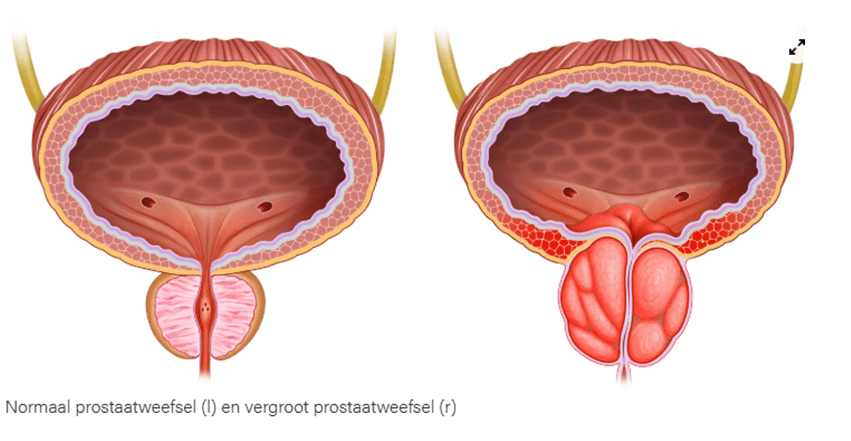 Links: normaal prostaatweefsel en rechts: vergroot prostaatweefsel